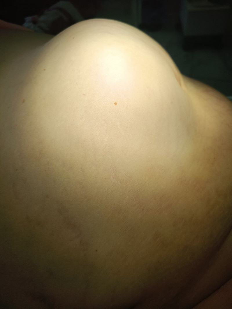 Волинські медики врятували 72-річну пацієнтку з величезною защемленою грижею та некрозом кишківника