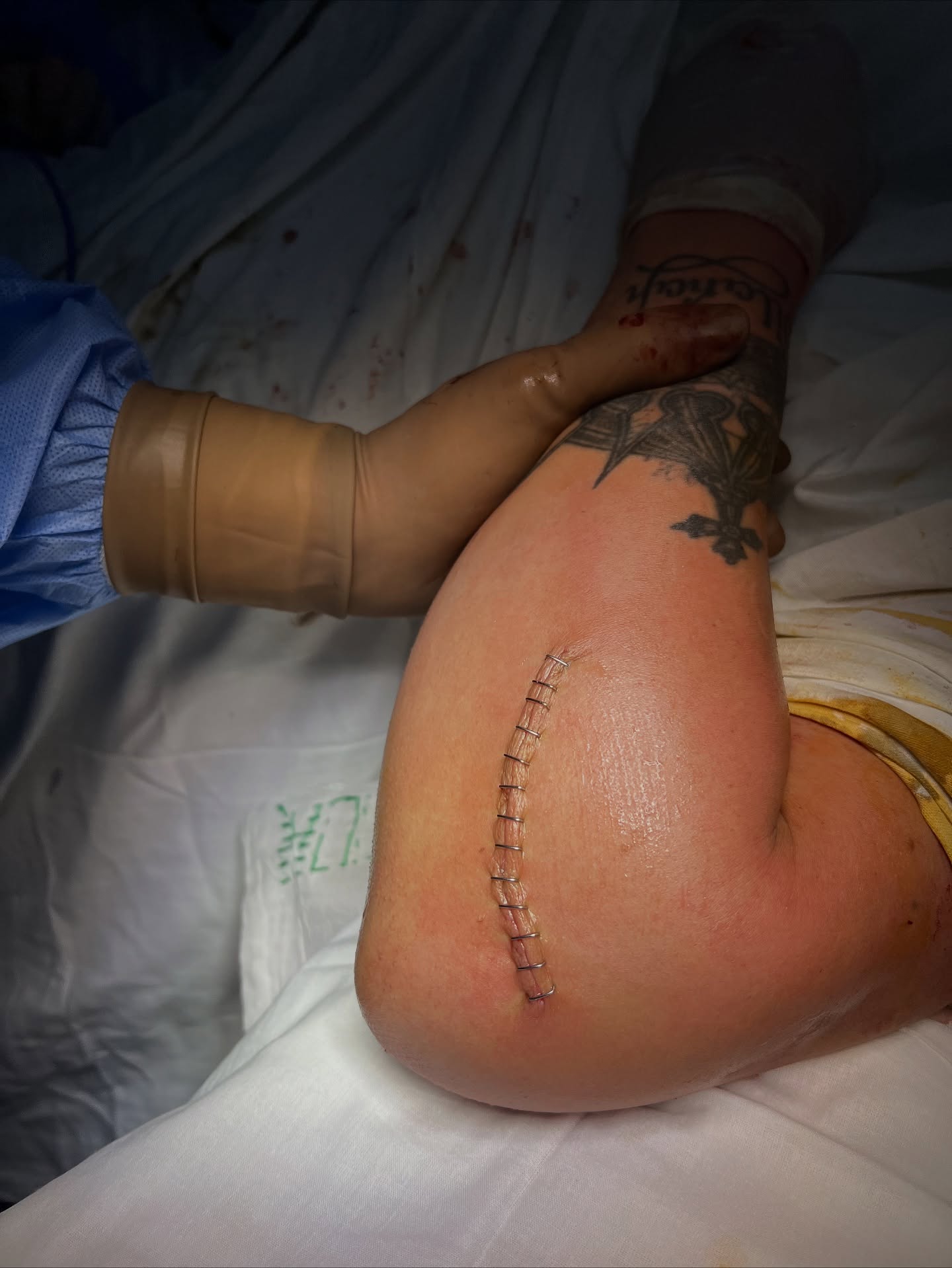 На Волині медики врятували чоловіка з тяжкою травмою ліктів після падіння з висоти