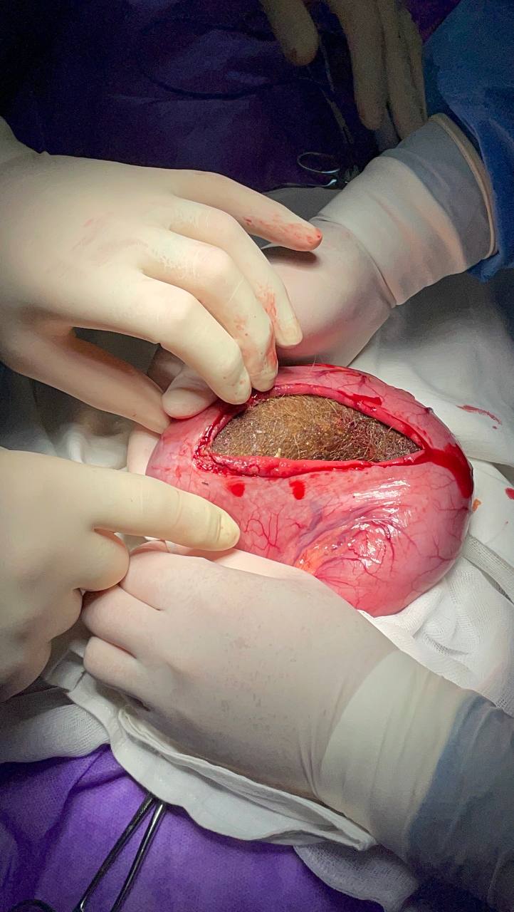 «Мала поганий апетит і розлади травлення»: волинські медики дістали зі шлунка дівчинки 700 грамів волосся. Фото 18+