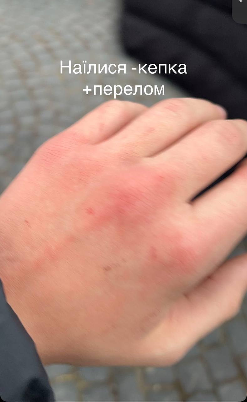 Синці та порваний одяг: у Тернополі під час роздачі безплатних бургерів підлітки мало не затоптали одне одного. Відео