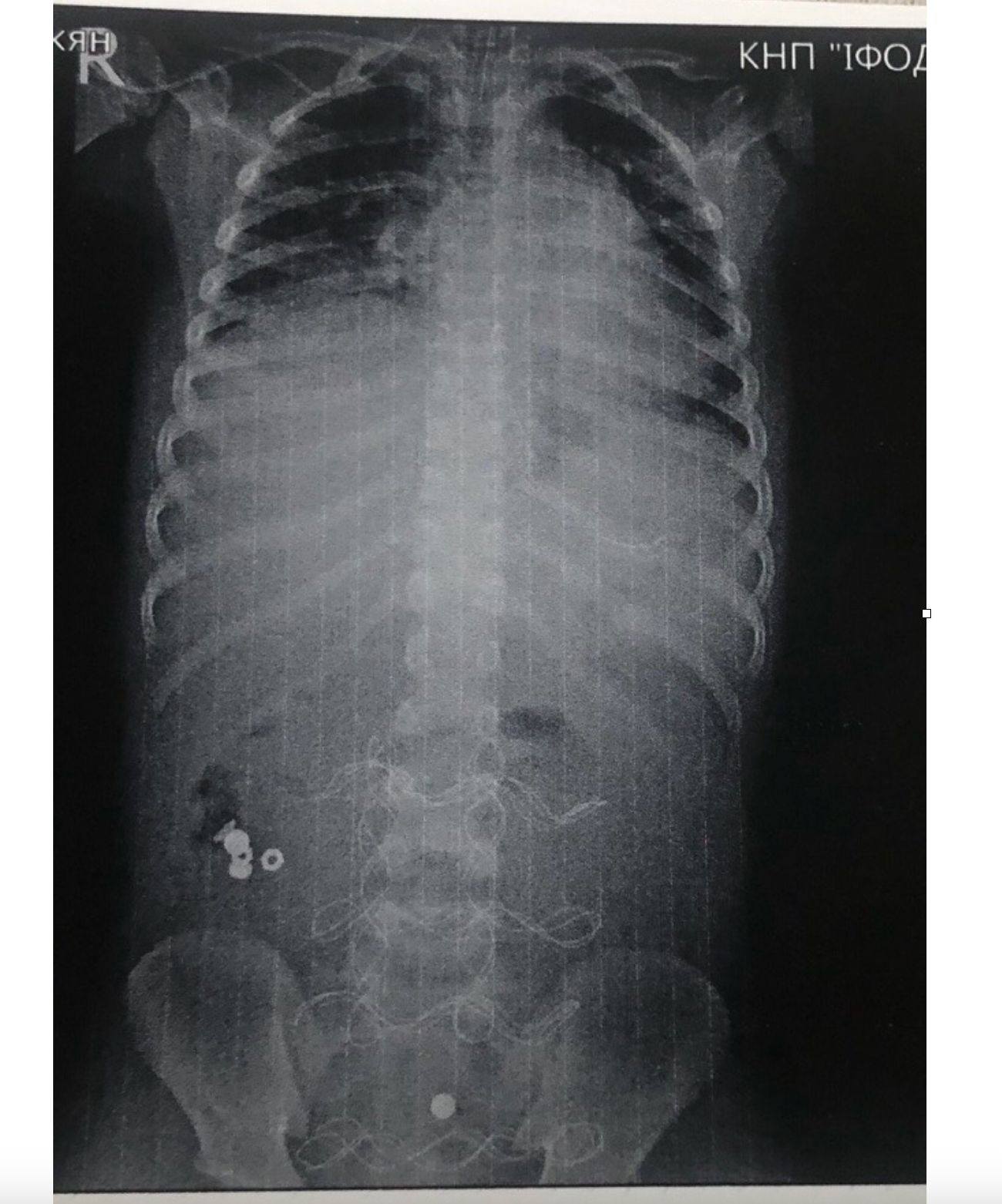 Проковтнув батарейку та опинився на межі життя і смерті – лікарі врятували 7-річного хлопчика