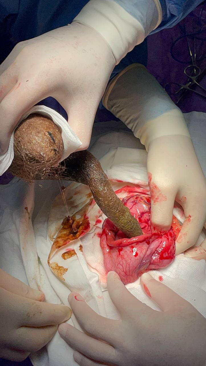 «Мала поганий апетит і розлади травлення»: волинські медики дістали зі шлунка дівчинки 700 грамів волосся. Фото 18+