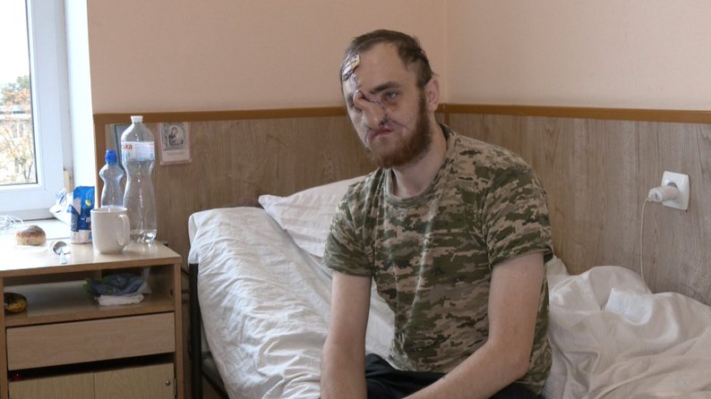 «Взагалі не було носа»: команда хірургів відновлюють обличчя 28-річному військовому з Волині