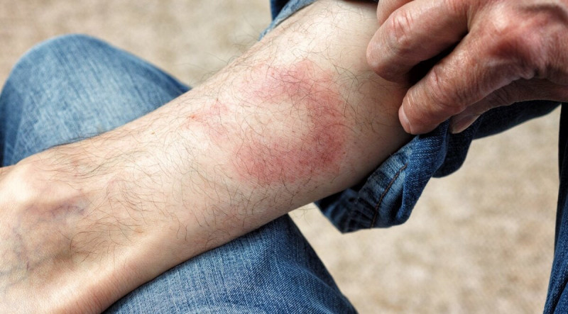 Кліщі на Волині: як вберегтися та що робити при укусі?