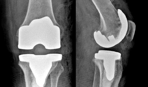 У райлікарні на Волині провели складну операцію із заміни деформованого колінного суглобу