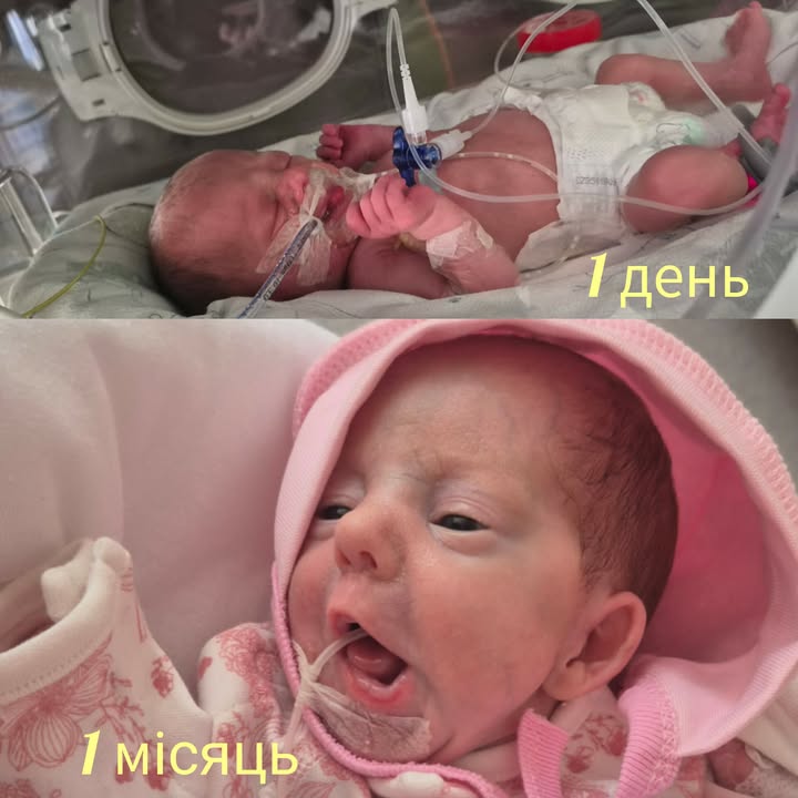 У Луцьку медики виходили дівчинку-«поспішайку», яка народилася з вагою лише 1240 грамів