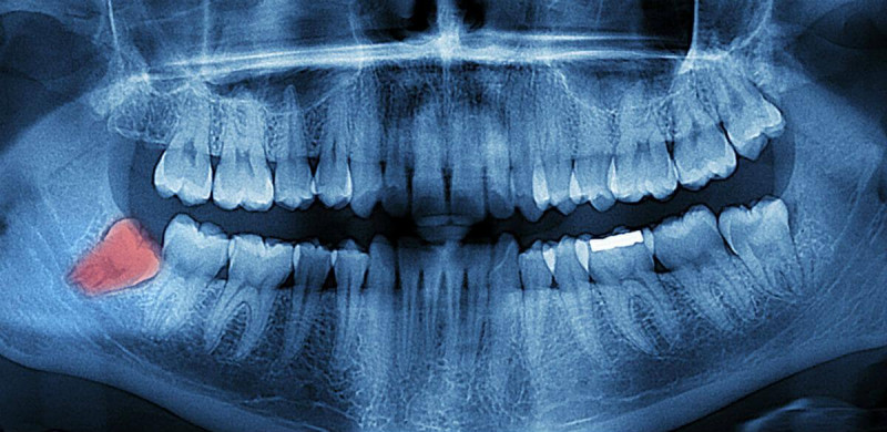 Чи видаляти зуби мудрості і скільки це коштує у Луцьку? Відповідь стоматологів