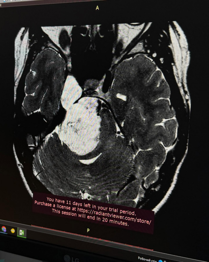 Повернулася з-за кордону за порятунком: 25-річній волинянці видалили велику пухлину головного мозку