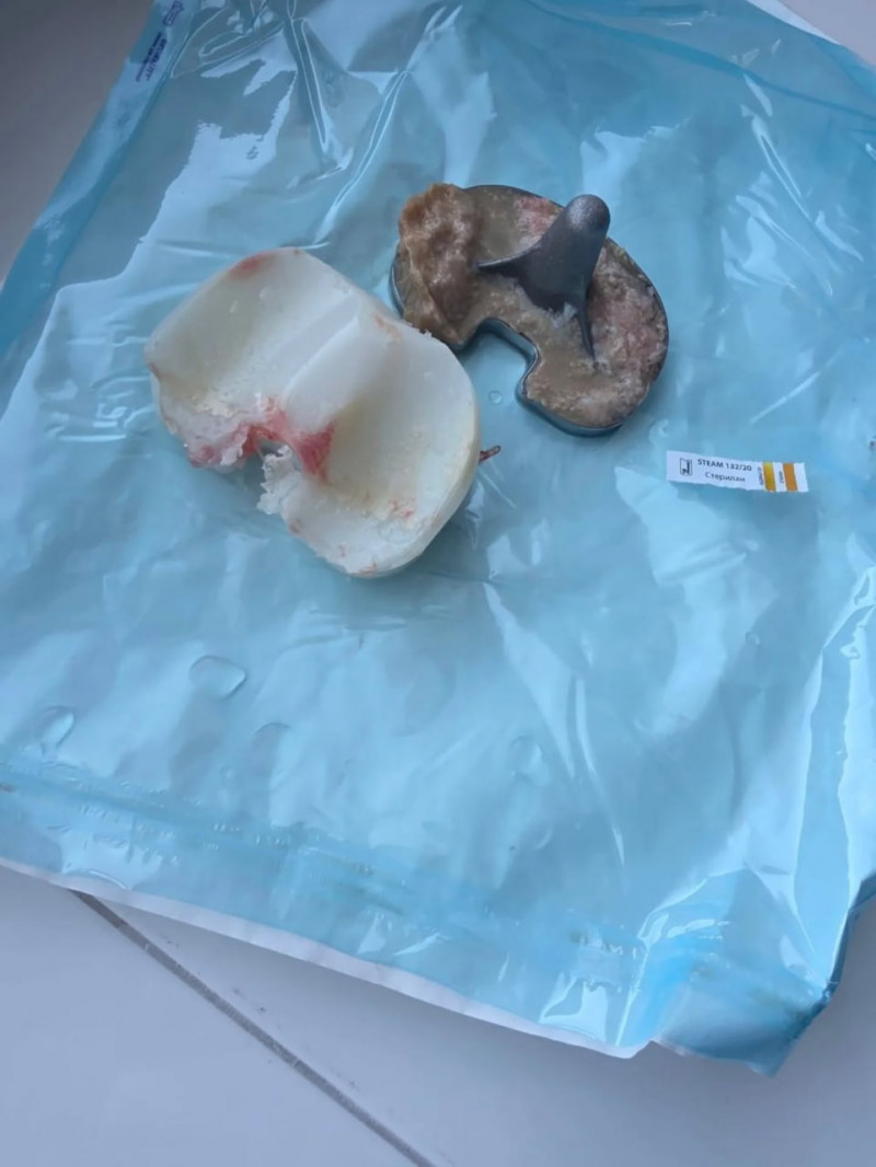 На Волині лікарі успішно провели складну операцію з індивідуальним 3D-протезом