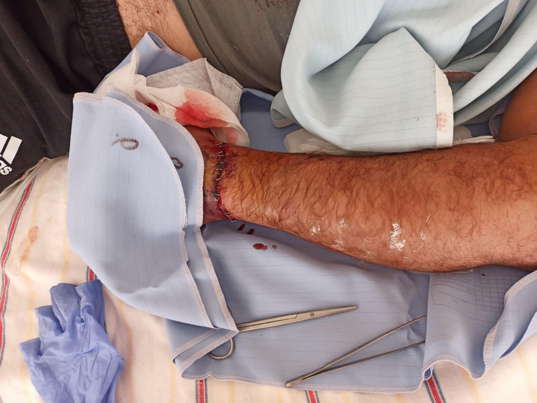 Ледь трималася на шкірі: у Луцьку хірурги пришили руку 37-річному чоловіку. Фото 18+