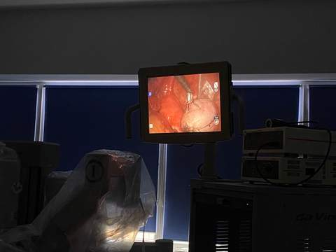 Хірурги з допомогою робота видалили жінці семисантиметрову пухлину