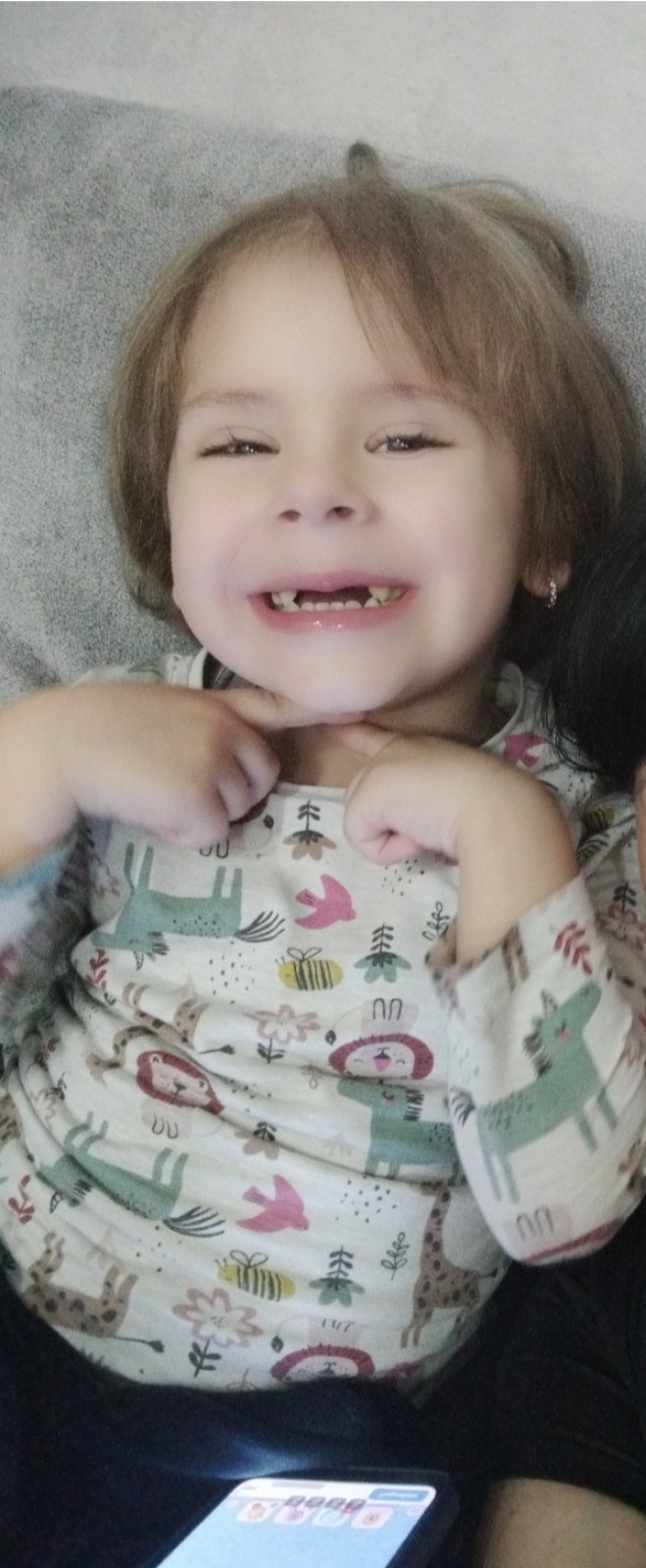 Маленькій лучанці Єві з двобічною нефробластомою провели надскладну операцію та зберегли обидві нирки