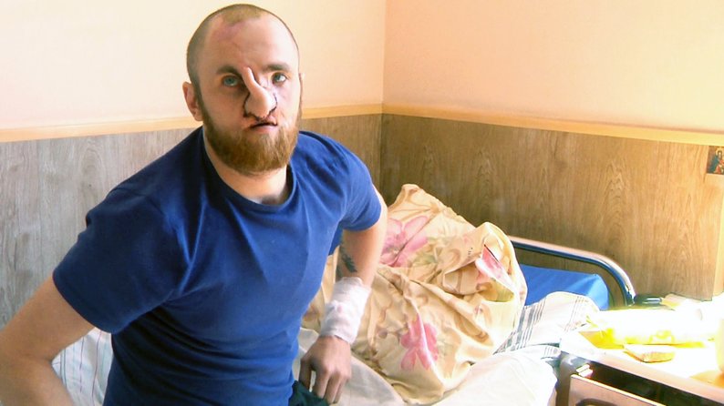 «Взагалі не було носа»: команда хірургів відновлюють обличчя 28-річному військовому з Волині