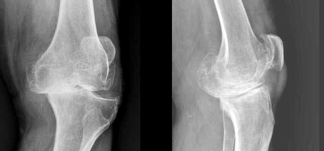У райлікарні на Волині провели складну операцію із заміни деформованого колінного суглобу
