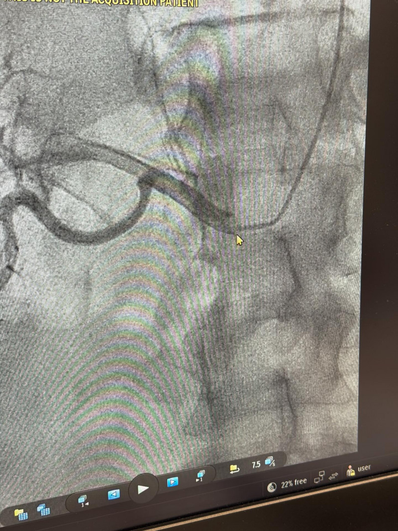 У лікарні на Волині використовують високоточне обстеження судин для лікування неконтрольованого тиску