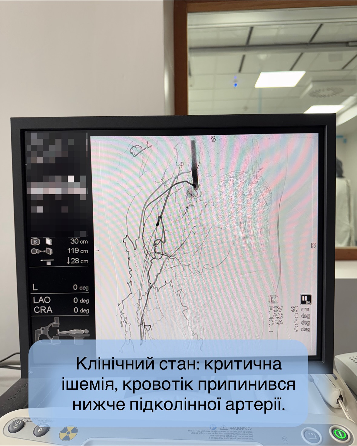 Кінцівка «ожила» на операційному столі: волинські медики врятували ногу пацієнта від ампутації