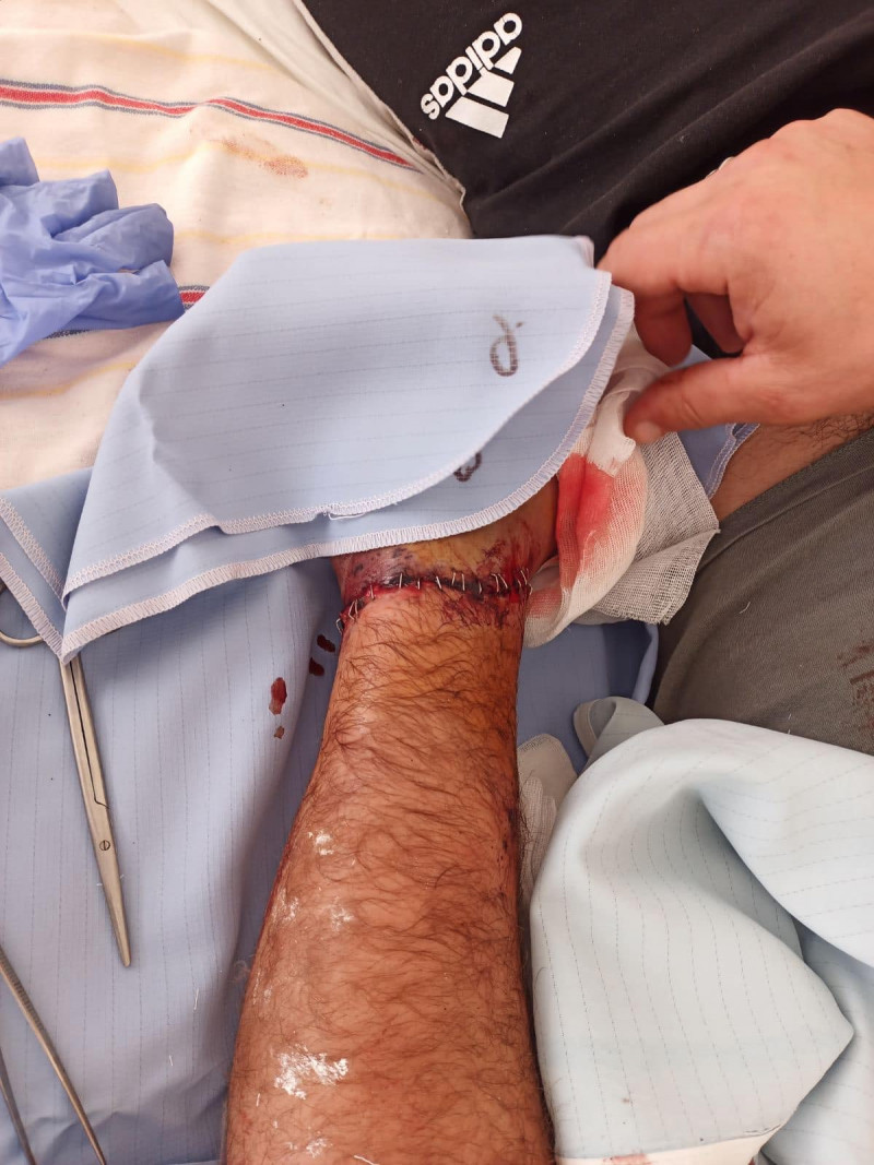 Ледь трималася на шкірі: у Луцьку хірурги пришили руку 37-річному чоловіку. Фото 18+