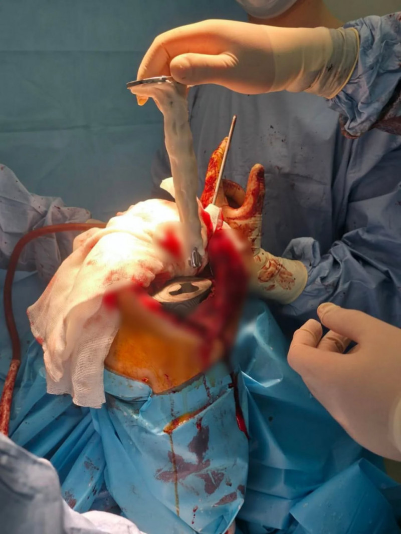 На Волині лікарі успішно провели складну операцію з індивідуальним 3D-протезом