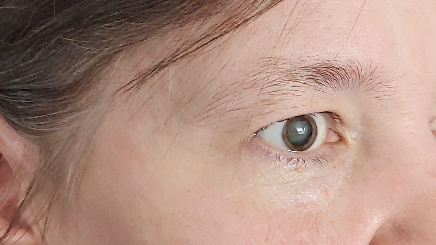Осліпла на рік: волинські медики відновили зір жінці