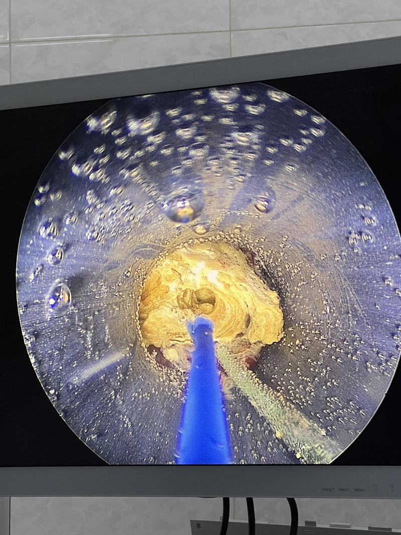 У волинській лікарні через 5-мм прокол чоловіку видалили 25-мм камінь з нирки