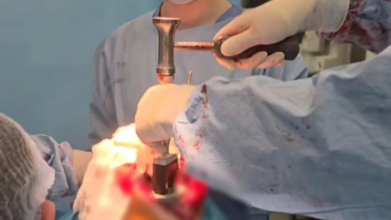 На Волині лікарі успішно провели складну операцію з індивідуальним 3D-протезом