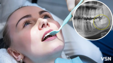 Чи видаляти зуби мудрості і скільки це коштує у Луцьку? Відповідь стоматологів