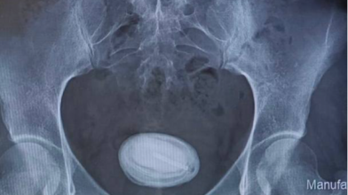 Причина - у протизаплідній спіралі: з сечового міхура пацієнтки видалили камінь «як куряче яйце»