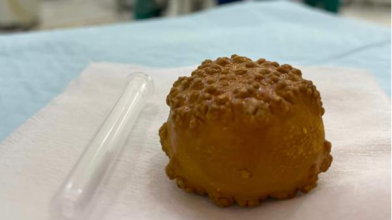 На Волині хірурги видалили з сечового міхура пацієнта 5-сантиметровий камінь