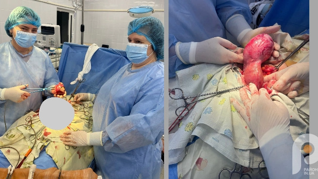 На Волині жінці видалили велику пухлину матки, зберігши можливість стати мамою