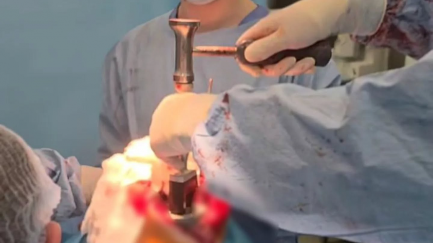 На Волині лікарі успішно провели складну операцію з індивідуальним 3D-протезом