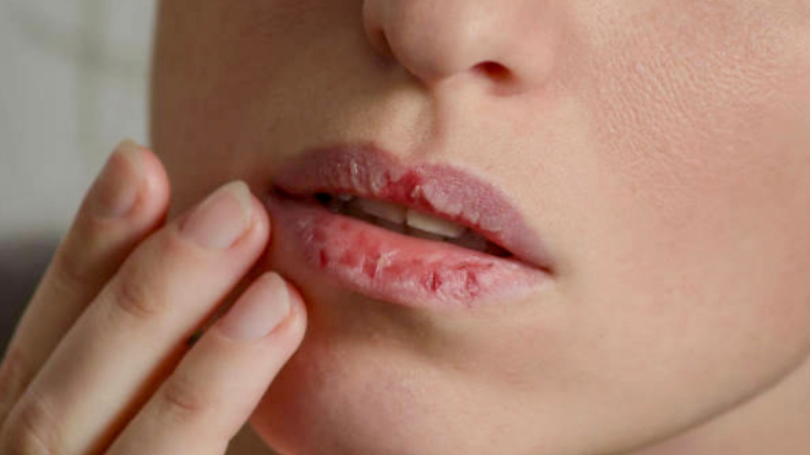 Чому сохнуть губи та як їх швидко відновити: прості й дієві поради