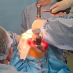 На Волині лікарі успішно провели складну операцію з індивідуальним 3D-протезом