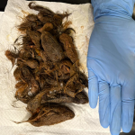 «Не могла їсти, схудла, мала постійну блювоту»: волинські медики дістали зі шлунка дівчинки 700 грамів волосся