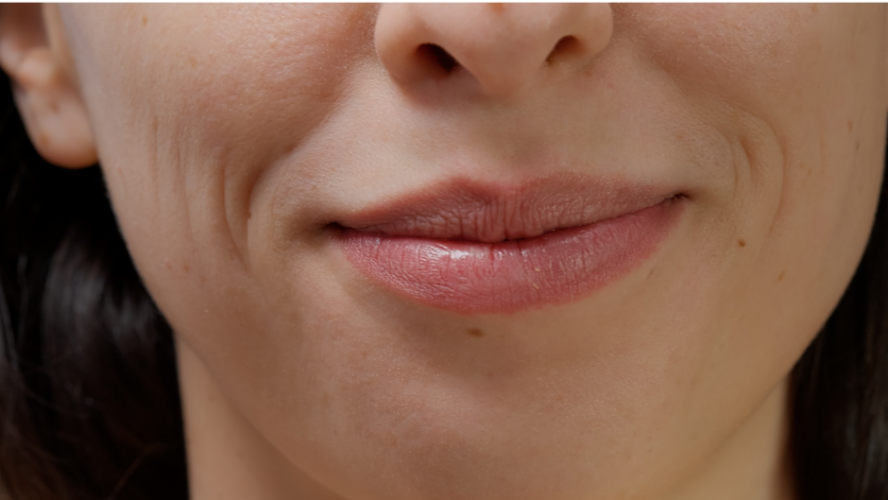 Контурна пластика носогубних складок: коли потрібна