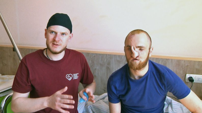 «Взагалі не було носа»: команда хірургів відновлюють обличчя 28-річному військовому з Волині