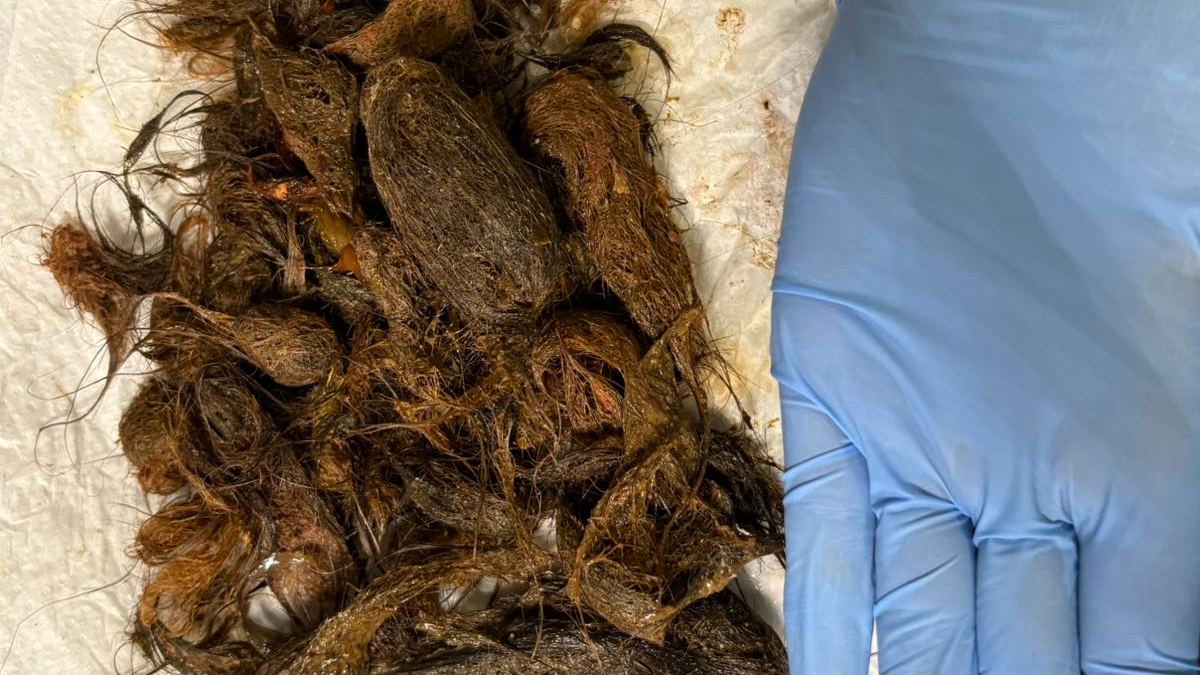 «Не могла їсти, схудла, мала постійну блювоту»: волинські медики дістали зі шлунка дівчинки 700 грамів волосся