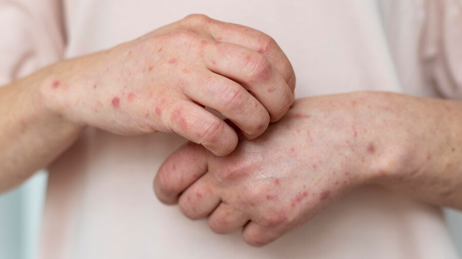 В Україні фіксують зростання захворюваності на вітрянку: яка ситуація на Волині