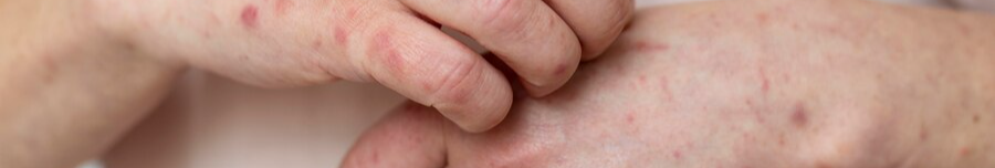 В Україні фіксують зростання захворюваності на вітрянку: яка ситуація на Волині